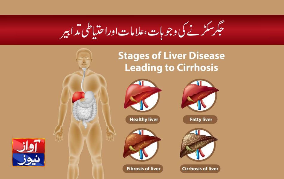 liver cirrhosis symptoms in urdu